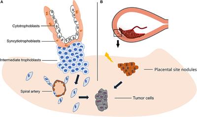 A Review on the Pathogenesis and Clinical Management of Placental Site Trophoblastic Tumors